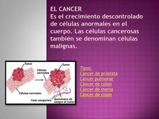 Tipos:
Cáncer de próstata
Cáncer pulmonar
Cáncer de colon
Cáncer de mama
Cáncer de colon
 