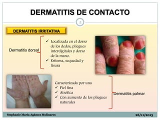 DERMATITIS DE CONTACTO
5

DERMATITIS IRRITATIVA

Dermatitis dorsal

 Localizada en el dorso
de los dedos, pliegues
interdigitales y dorso
de la mano.
 Eritema, sequedad y
fisura

Caracterizada por una
 Piel fina
 Atrófica
 Con aumento de los pliegues
naturales
Stephanie María Agámez Molinares

Dermatitis palmar

26/11/2013

 