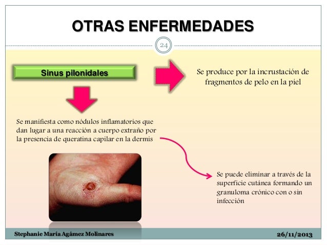 OTRAS ENFERMEDADES
24
Sinus pilonidales
Se produce por la incrustación de
fragmentos de pelo en la piel
Se manifiesta c...