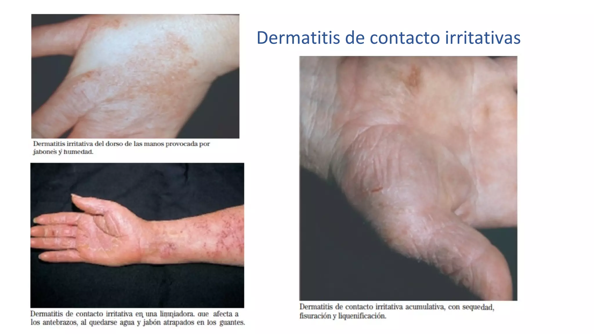 Dermatitis de contacto irritativas
 