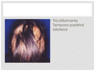 • Tricotilomania
Temporo-parietal
bilateral

 