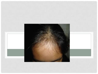 TRICOTILOMANIA FRONTAL

 