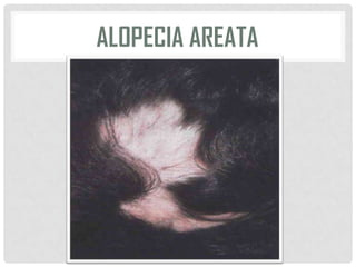 ALOPECIA AREATA

 