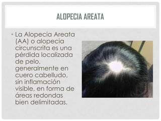 ALOPECIA AREATA
• La Alopecia Areata
(AA) o alopecia
circunscrita es una
pérdida localizada
de pelo,
generalmente en
cuero cabelludo,
sin inflamación
visible, en forma de
áreas redondas
bien delimitadas.

 