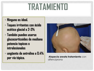TRATAMIENTO
• Ninguno es ideal.
• Toques irritantes con ácido
acético glacial a 2-3%
• También pueden usarse
glucocorticoides de mediana
potencia topicos o
intralesionales
• ungüento de antralina a 0.4%
por vía tópica.

Alopecia areata tratamiento con
difenciprona

 