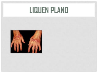 LIQUEN PLANO

 