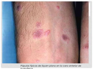 Pápulas típicas de liquen plano en la cara anterior de

 
