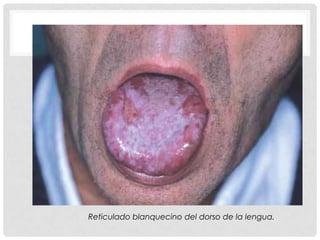 Reticulado blanquecino del dorso de la lengua.

 