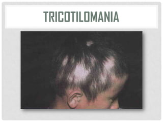 TRICOTILOMANIA

 
