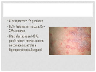 • Al desaparecer  pardusca
• 65%, lesiones en mucosa, 15 –
35% aisladas
• Uñas afectadas en 1-16%:
puede haber : estrías, surcos,
onicomadesis, atrofia e
hiperqueratosis subungueal

 