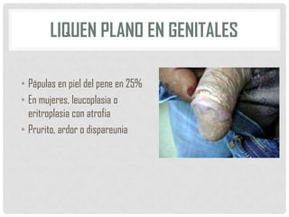 LIQUEN PLANO EN GENITALES
• Pápulas en piel del pene en 25%
• En mujeres, leucoplasia o
eritroplasia con atrofia
• Prurito, ardor o dispareunia

 