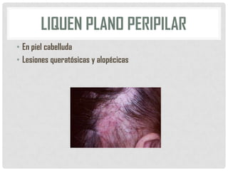 LIQUEN PLANO PERIPILAR
• En piel cabelluda
• Lesiones queratósicas y alopécicas

 