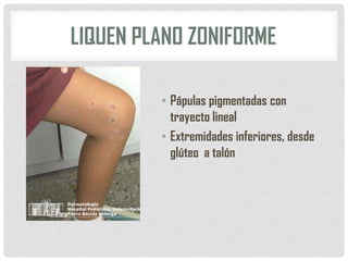 LIQUEN PLANO ZONIFORME
• Pápulas pigmentadas con
trayecto lineal
• Extremidades inferiores, desde
glúteo a talón

 