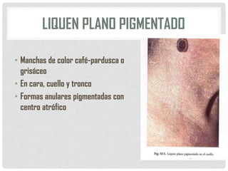 LIQUEN PLANO PIGMENTADO
• Manchas de color café-pardusca o
grisáceo
• En cara, cuello y tronco
• Formas anulares pigmentadas con
centro atrófico

 