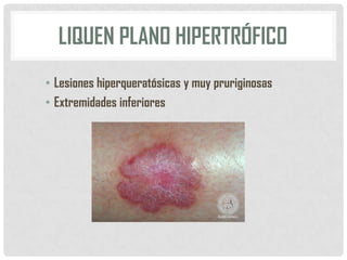 LIQUEN PLANO HIPERTRÓFICO
• Lesiones hiperqueratósicas y muy pruriginosas
• Extremidades inferiores

 