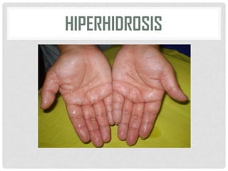HIPERHIDROSIS

 