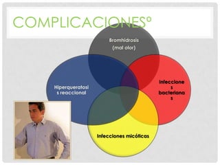 COMPLICACIONESº
Bromhidrosis
(mal olor)

Infeccione
s
bacteriana
s

Hiperqueratosi
s reaccional

Infecciones micóticas

 