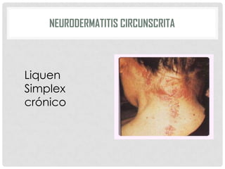 NEURODERMATITIS CIRCUNSCRITA

Liquen
Simplex
crónico

 