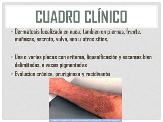 CUADRO CLÍNICO
• Dermatosis localizada en nuca, tambien en piernas, frente,
muñecas, escroto, vulva, ano u otros sitios.
• Una o varias placas con eritema, liquenificación y escamas bien
delimitadas, a veces pigmentadas
• Evolucion crónica, pruriginosa y recidivante

 