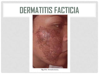 DERMATITIS FACTICIA

 