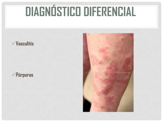 DIAGNÓSTICO DIFERENCIAL
Vasculitis

Púrpuras

 