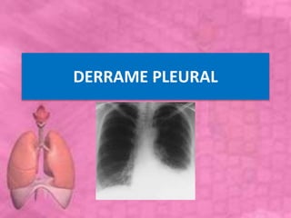 DERRAME PLEURAL
 