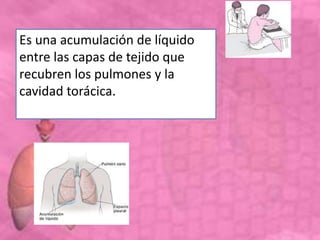 Es una acumulación de líquido
entre las capas de tejido que
recubren los pulmones y la
cavidad torácica.
 