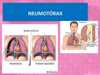 NEUMOTÓRAX
 