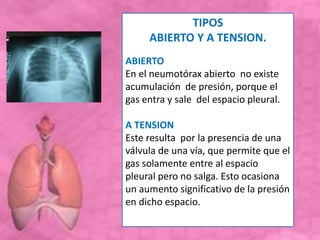 TIPOS
ABIERTO Y A TENSION.
ABIERTO
En el neumotórax abierto no existe
acumulación de presión, porque el
gas entra y sale del espacio pleural.
A TENSION
Este resulta por la presencia de una
válvula de una vía, que permite que el
gas solamente entre al espacio
pleural pero no salga. Esto ocasiona
un aumento significativo de la presión
en dicho espacio.
 