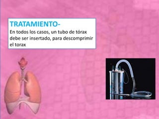 TRATAMIENTO-
En todos los casos, un tubo de tórax
debe ser insertado, para descomprimir
el torax
 