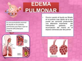 EDEMA
PULMONAR
• Ocurre cuando el liquido es filtrado
en el pulmón mas rápido de lo que
puede ser removido produciendo
una alteración importante del
intercambio gaseoso, por
acumulación del mismo en el
espacio extravascular del pulmón
Es una acumulación anormal
de líquido en los alvéolos
pulmonares que lleva a que se
presente dificultad para
respirar.
 