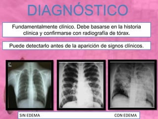Fundamentalmente clínico. Debe basarse en la historia
clínica y confirmarse con radiografía de tórax.
DIAGNÓSTICO
Puede detectarlo antes de la aparición de signos clínicos.
SIN EDEMA CON EDEMA
 