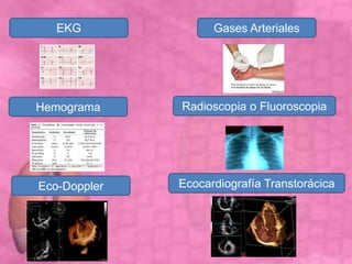 EKG
Hemograma
Eco-Doppler
Gases Arteriales
Radioscopia o Fluoroscopia
Ecocardiografía Transtorácica
 