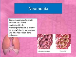Neumonía
Es una infección del pulmón
caracterizada por la
multiplicación de
microorganismos en el interior
de los alvéolos, lo que provoca
una inflamación con daño
pulmonar.
 