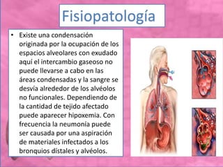 • Existe una condensación
originada por la ocupación de los
espacios alveolares con exudado
aquí el intercambio gaseoso no
puede llevarse a cabo en las
áreas condensadas y la sangre se
desvía alrededor de los alvéolos
no funcionales. Dependiendo de
la cantidad de tejido afectado
puede aparecer hipoxemia. Con
frecuencia la neumonía puede
ser causada por una aspiración
de materiales infectados a los
bronquios dístales y alvéolos.
Fisiopatología
 