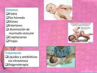 Síntomas
Fiebre
Tos húmeda
Disnea
Estertores
 disminución de
murmullo vesicular
Crepitaciones
Tirajes
Tratamiento
Líquidos y antibióticos
vía intravenosa
Oxigenoterapia.
 