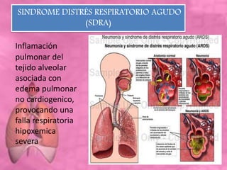 SINDROME DISTRÉS RESPIRATORIO AGUDO
(SDRA)
Inflamación
pulmonar del
tejido alveolar
asociada con
edema pulmonar
no cardiogenico,
provocando una
falla respiratoria
hipoxemica
severa
 