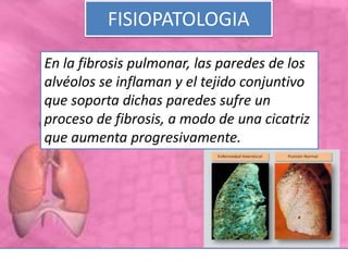 FISIOPATOLOGIA
En la fibrosis pulmonar, las paredes de los
alvéolos se inflaman y el tejido conjuntivo
que soporta dichas paredes sufre un
proceso de fibrosis, a modo de una cicatriz
que aumenta progresivamente.
 