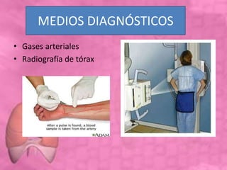MEDIOS DIAGNÓSTICOS
• Gases arteriales
• Radiografía de tórax
 