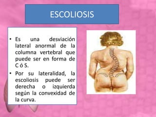 ESCOLIOSIS
• Es una desviación
lateral anormal de la
columna vertebral que
puede ser en forma de
C ó S.
• Por su lateralidad, la
escoliosis puede ser
derecha o izquierda
según la convexidad de
la curva.
 