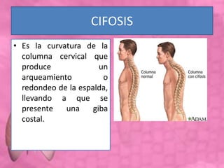 CIFOSIS
• Es la curvatura de la
columna cervical que
produce un
arqueamiento o
redondeo de la espalda,
llevando a que se
presente una giba
costal.
 