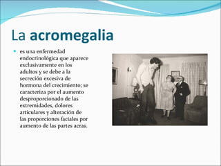 La  acromegalia   es una enfermedad endocrinológica que aparece exclusivamente en los adultos y se debe a la secreción excesiva de hormona del crecimiento; se caracteriza por el aumento desproporcionado de las extremidades, dolores articulares y alteración de las proporciones faciales por aumento de las partes acras. 