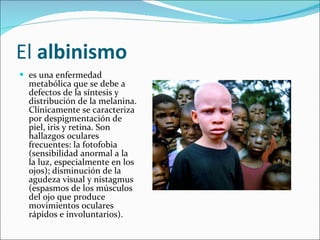 El  albinismo   es una enfermedad metabólica que se debe a defectos de la síntesis y distribución de la melanina. Clínicamente se caracteriza por despigmentación de piel, iris y retina. Son hallazgos oculares frecuentes: la fotofobia (sensibilidad anormal a la la luz, especialmente en los ojos); disminución de la agudeza visual y nistagmus (espasmos de los músculos del ojo que produce movimientos oculares rápidos e involuntarios). 