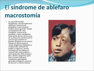 El  síndrome de ablefaro macrostomía   es una enfermedad hereditaria, caracterizado por abléfaron (ausencia de párpados) y macrostomía (orificio bucal grande). Puede acompañarse de: cara triangular, ausencia de pestañas y cejas, estrabismo (desviación de uno de los ojos de su dirección normal, por lo que los ejes visuales no pueden dirigirse en un mismo tiempo al mismo punto), orejas displásicas (displasia es el desarrollo anómalo de tejidos u órganos), atresia (oclusión de una abertura natural) del canal auditivo, nariz pequeña, labio superior fino, dientes pequeños, pelo fino y escaso, piel seca, membrana interdigital, genitales ambiguos, ausencia de escroto y retraso mental.  