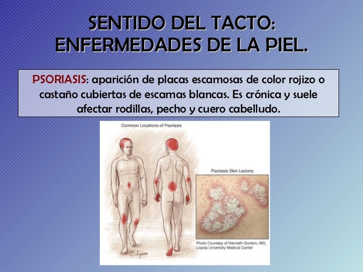 Los síntomas de la psoriasis sobre las orejas
