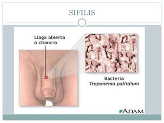 SIFILIS
