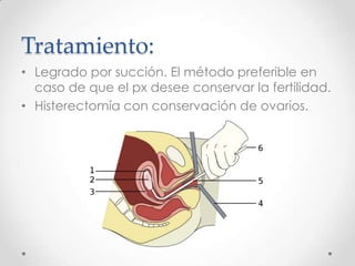 Tratamiento:
• Legrado por succión. El método preferible en
  caso de que el px desee conservar la fertilidad.
• Histerectomía con conservación de ovarios.
 