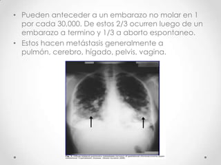 • Pueden anteceder a un embarazo no molar en 1
  por cada 30,000. De estos 2/3 ocurren luego de un
  embarazo a termino y 1/3 a aborto espontaneo.
• Estos hacen metástasis generalmente a
  pulmón, cerebro, hígado, pelvis, vagina.
 