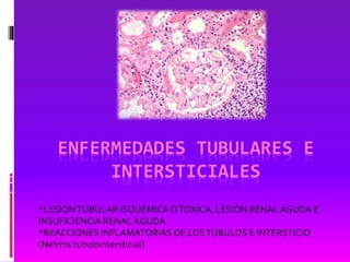 ENFERMEDADES TUBULARES E
INTERSTICIALES
*LESIÓNTUBULAR ISQUÉMICAOTÓXICA, LESIÓN RENALAGUDA E
INSUFICIENCIA RENALAGUDA
*REACCIONES INFLAMATORIAS DE LOSTÚBULOS E INTERSTICIO
(Nefritis tubulointersticial)
 