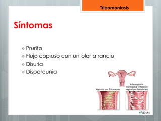 Síntomas 
 Prurito 
 Flujo copioso con un olor a rancio 
 Disuria 
 Dispareunia 
Tricomoniasis 
 